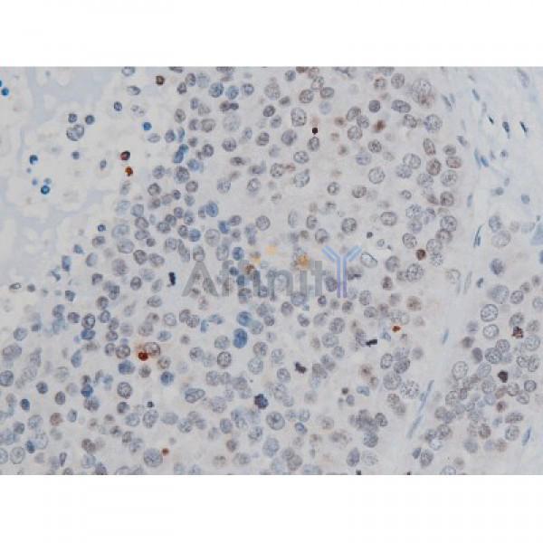 Phospho-Histone H2A.X (Ser139)[Ser140] Antibody - AF3187 at 1/200 staining Human liver cancer tissue sections by IHC-P.
